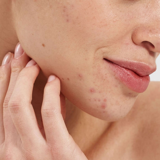 une peau à imperfections